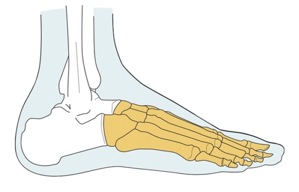 Niveaux d'amputation - Amputation avant-pied