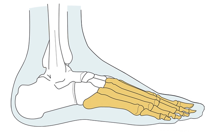 image-amputation-de-lisfranc_01